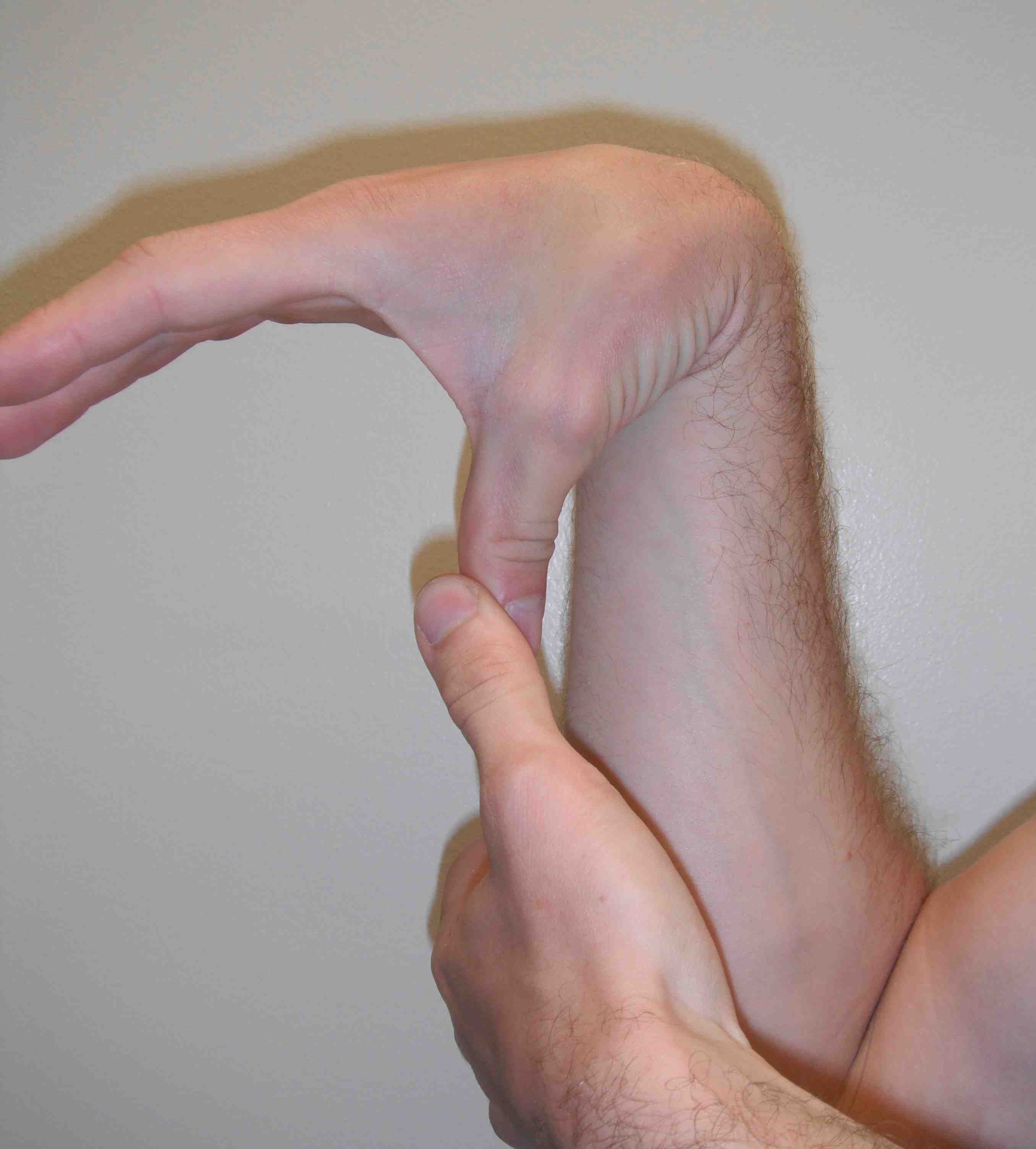 Ligamentous Laxity Thumb to Forearm